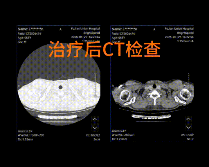 图片[2]-单孔胸腔镜左上肺癌根治术（新辅助化免后，肺动脉及支气管成形）