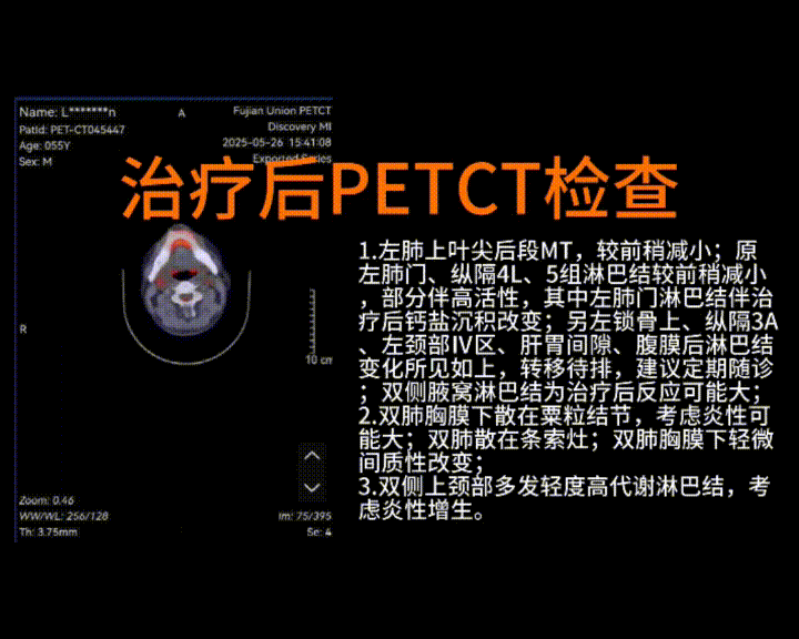 图片[3]-单孔胸腔镜左上肺癌根治术（新辅助化免后，肺动脉及支气管成形）