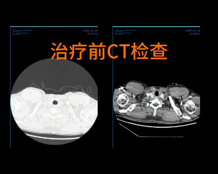 图片[1]-单孔胸腔镜左上肺癌根治术（新辅助化免后，肺动脉及支气管成形）