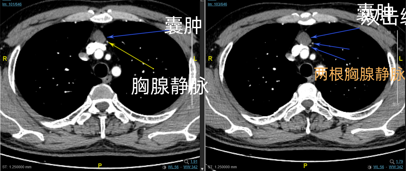 陆欣欣 剑突下左无名静脉前囊肿切除术未剪辑解说版