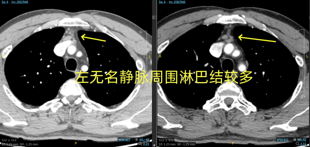 图片[2]-陆欣欣 剑突下胸腔镜纵隔肿瘤+胸腺切除加前纵隔淋巴结清扫术
