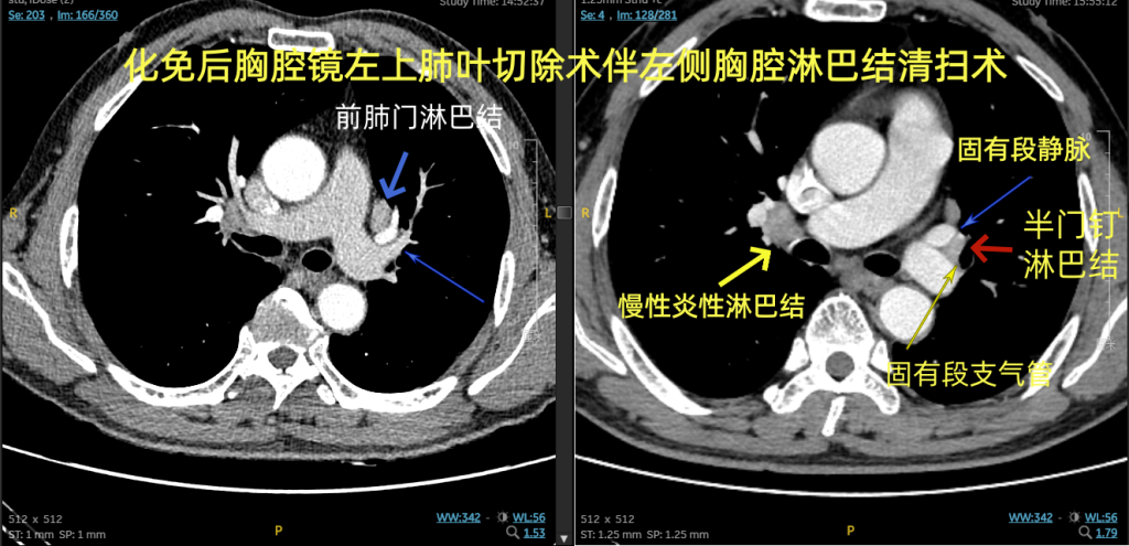 图片[1]-陆欣欣  胸腔镜左上肺切除伴半门钉淋巴结切除1.5倍速微剪辑