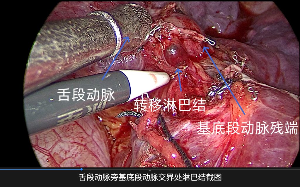 图片[1]-陆欣欣 膈肌过高的左下肺叶切除，纵隔淋巴结清扫（1.2倍速微剪辑解说版）