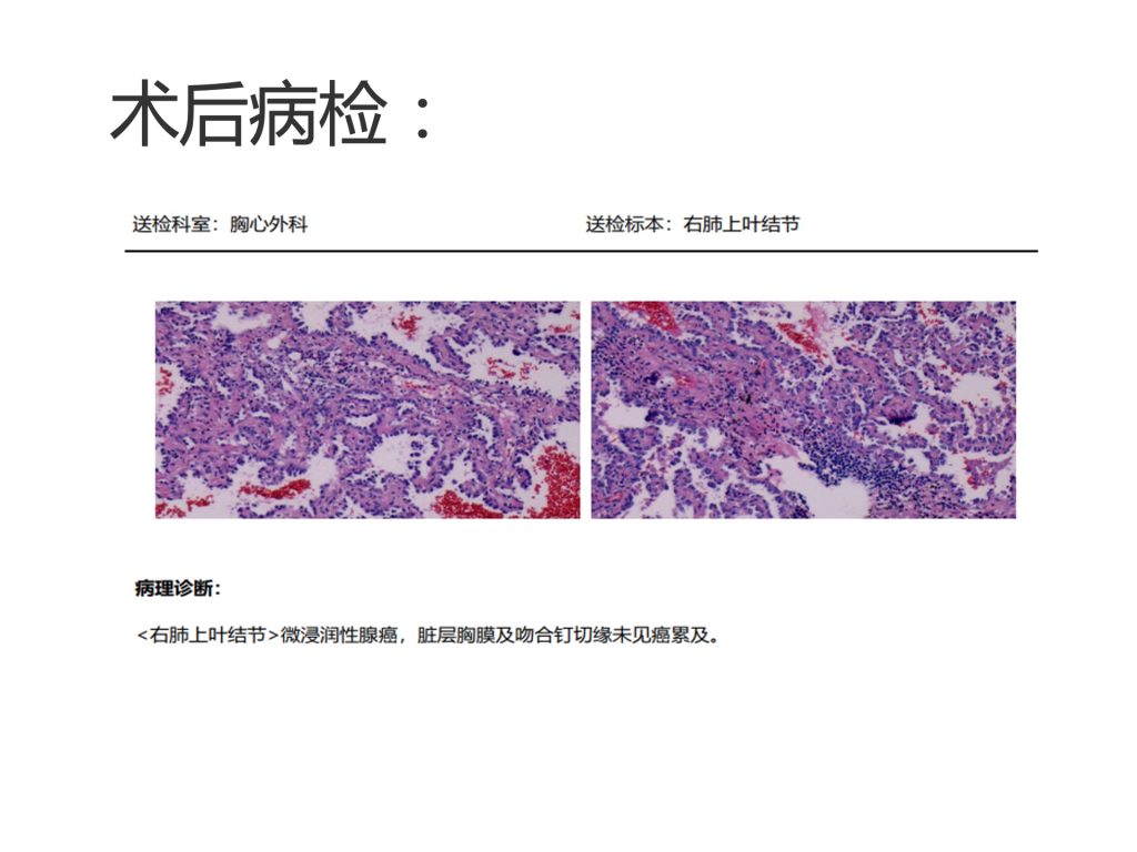 图片[5]-崔辉 单孔胸腔镜右肺上叶S1+S3a切除+系统性淋巴结清扫术