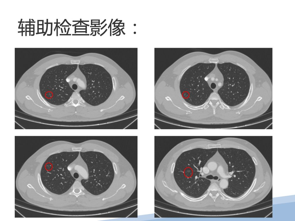图片[1]-崔辉 单孔胸腔镜右肺上叶S1+S3a切除+系统性淋巴结清扫术
