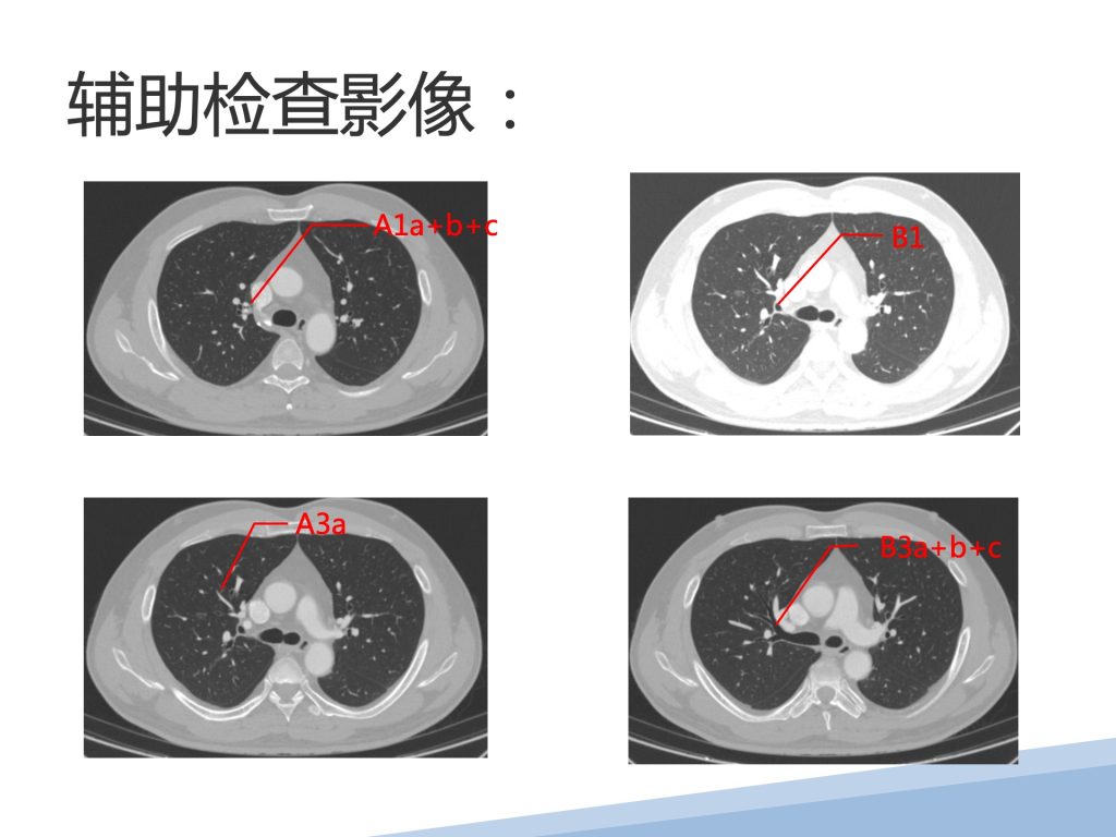 图片[2]-崔辉 单孔胸腔镜右肺上叶S1+S3a切除+系统性淋巴结清扫术