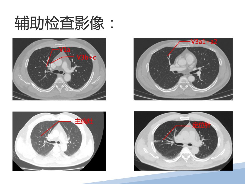 图片[3]-崔辉 单孔胸腔镜右肺上叶S1+S3a切除+系统性淋巴结清扫术