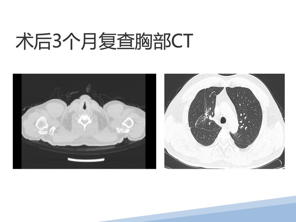 图片[4]-崔辉 单孔胸腔镜右肺上叶S1+S3a切除+系统性淋巴结清扫术