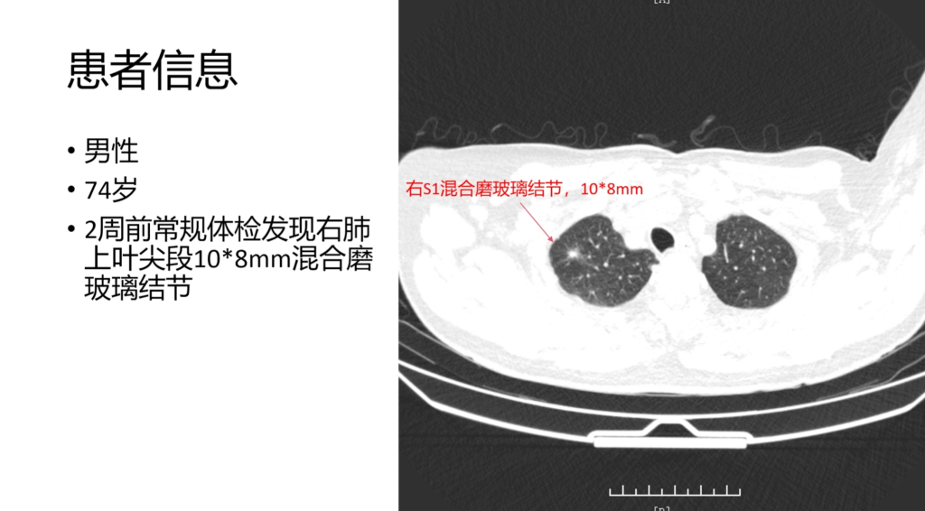 图片[1]-何畅 单孔胸腔镜右S1切除