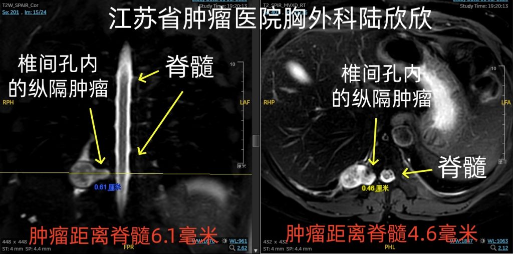 图片[1]-陆欣欣 侵犯椎间孔的右后纵隔纵隔肿瘤胸腔镜手术解说版